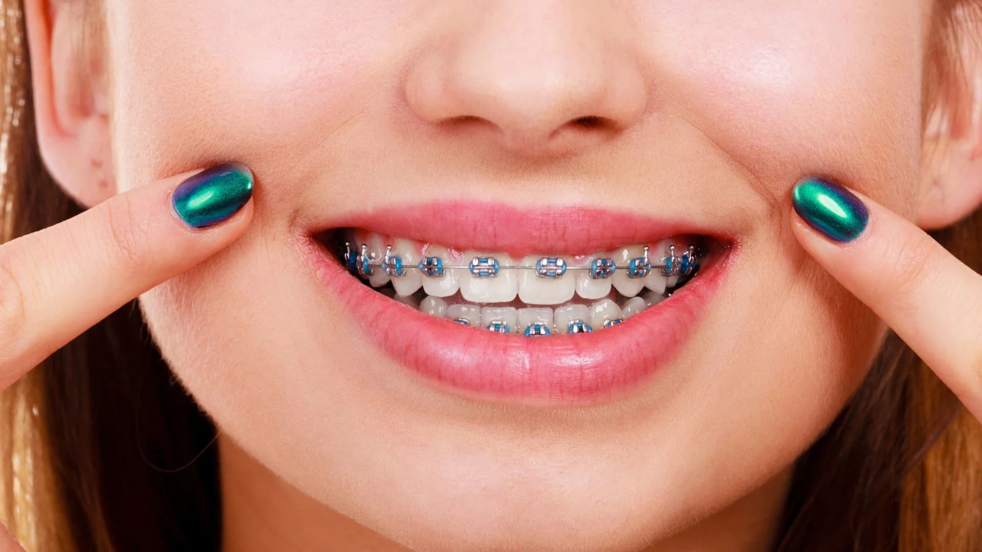 How much do braces cost in Australia - price guide